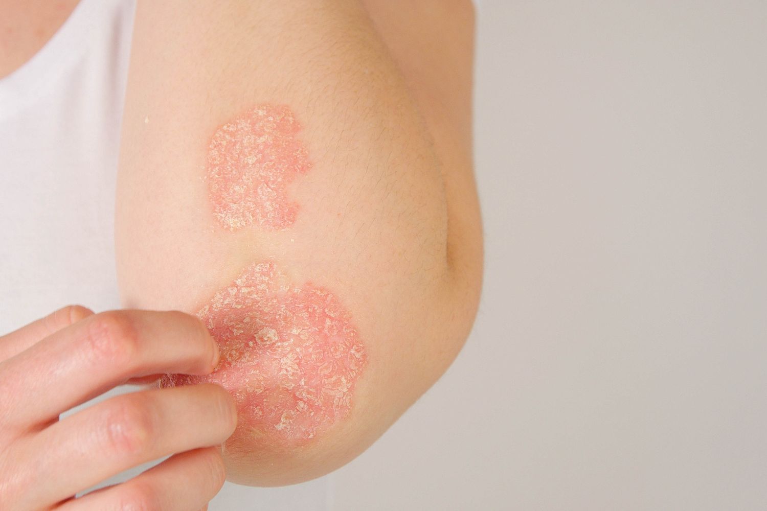 psoriasis_skin_condition_header