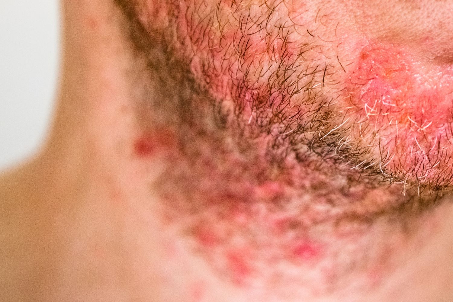 seborrheic dermatitis skin condition header