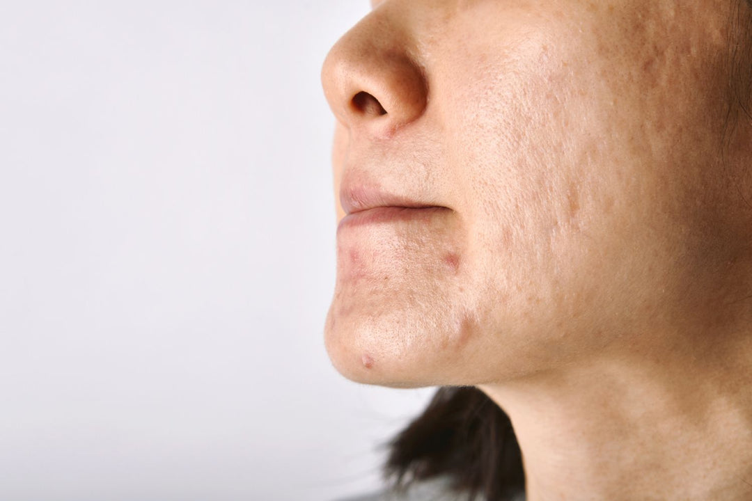 Acne Scarring: Symptoms, Treatment & Removal - Clever Soap