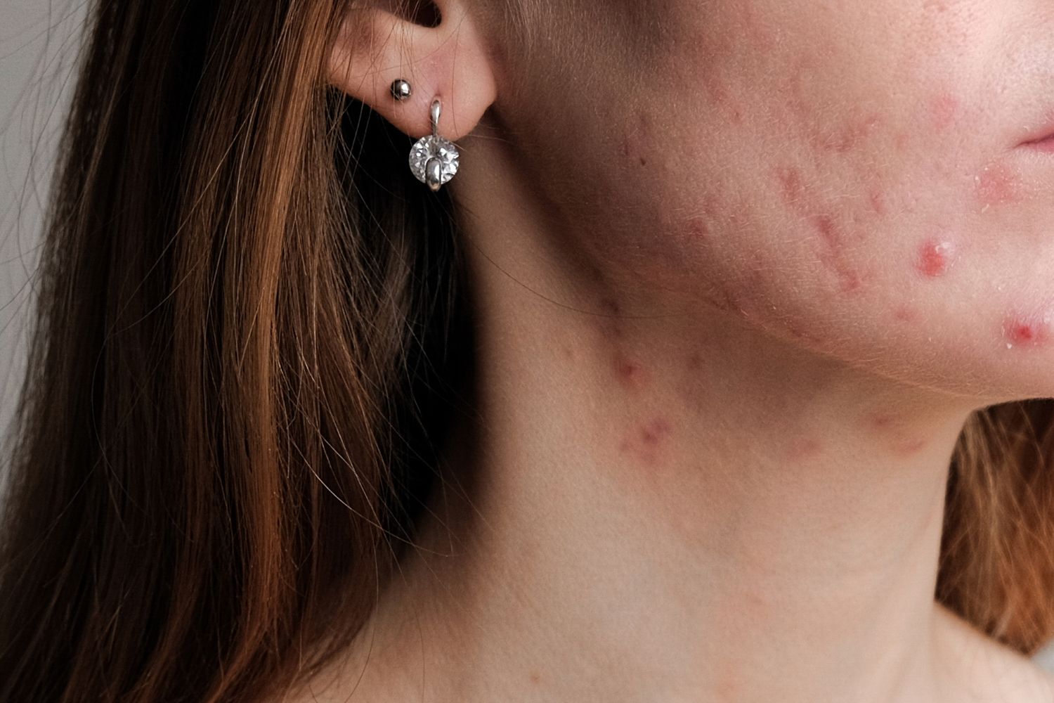 acne skin condition header