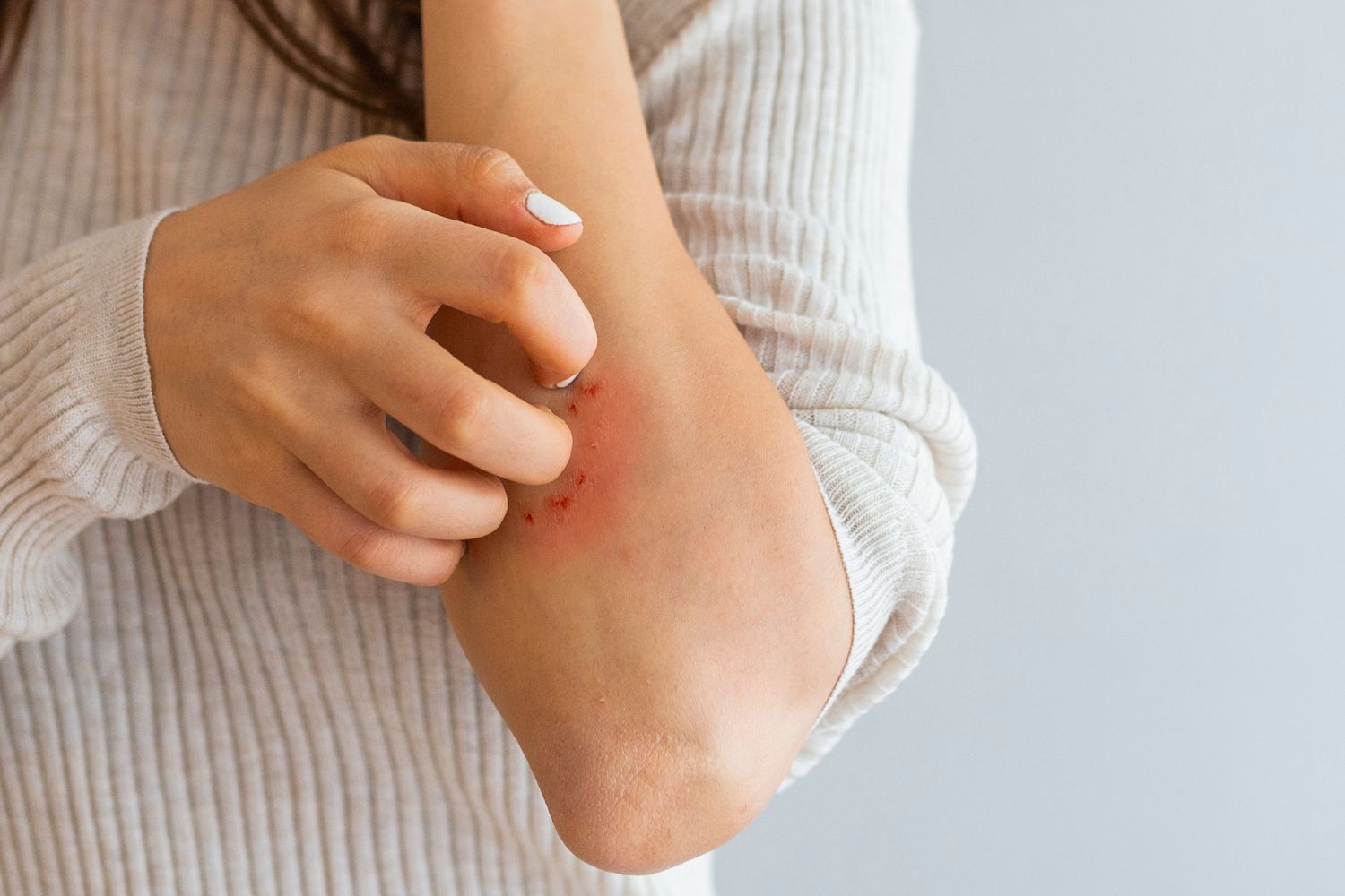 eczema skin condition header