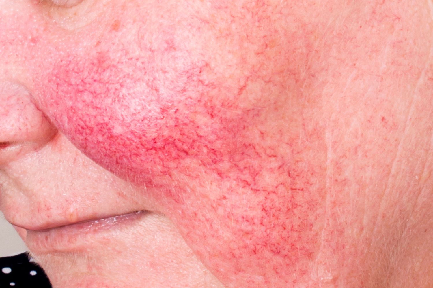 rosacea skin condition header