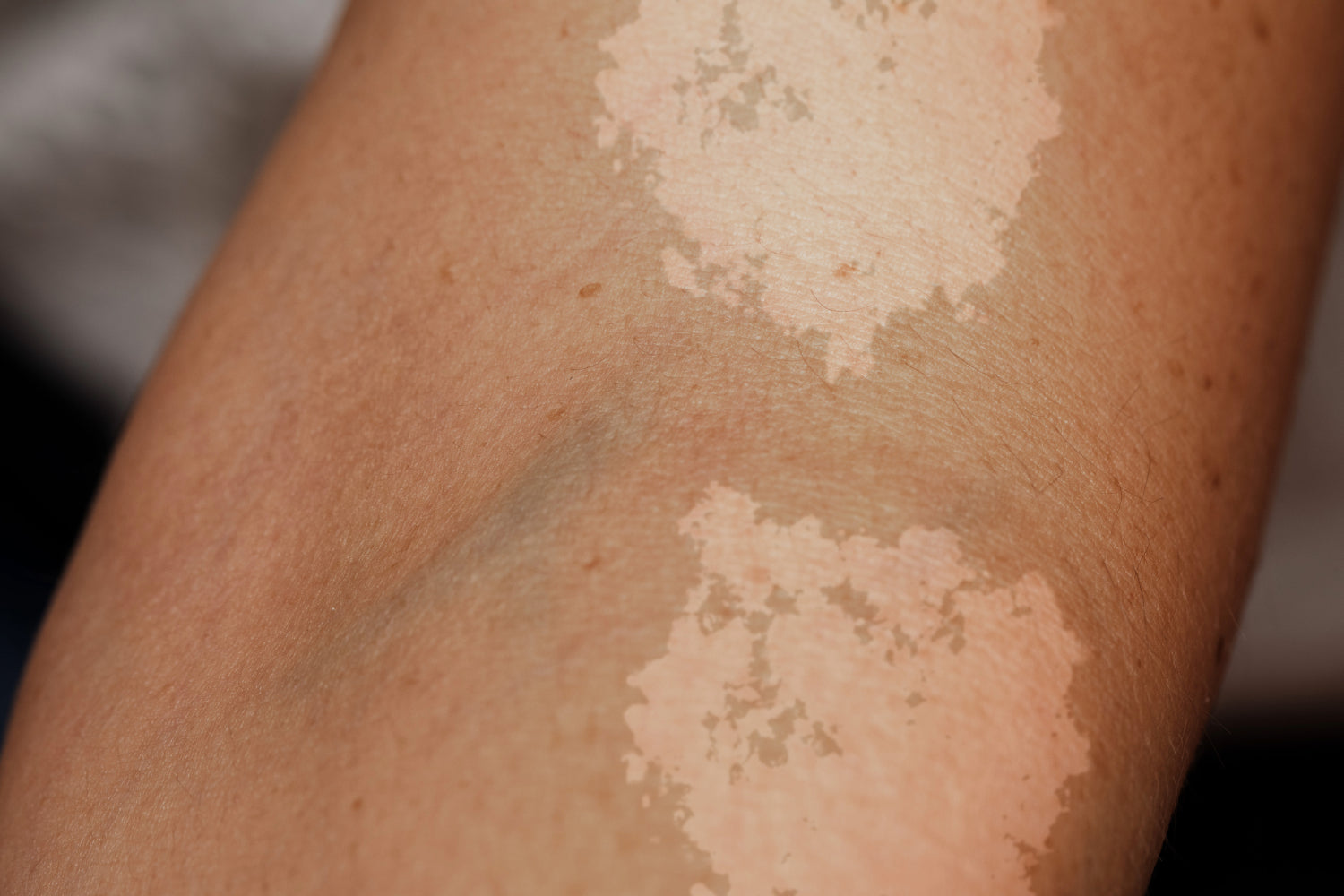 Tinea Versicolor