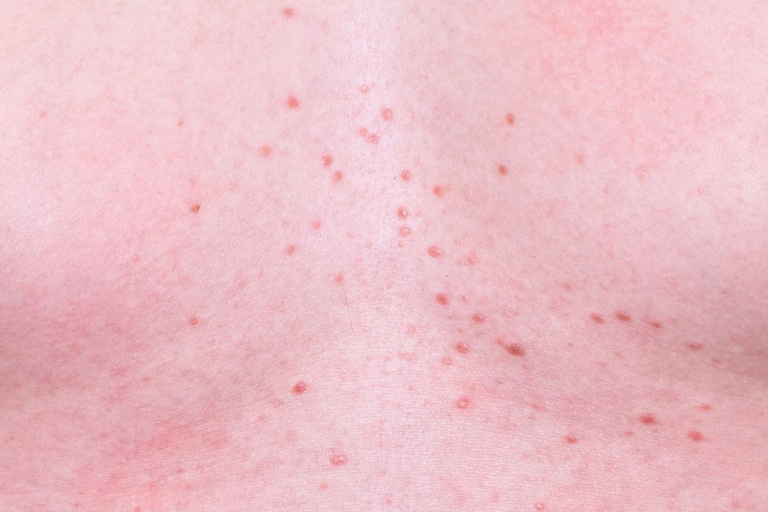 fungal acne