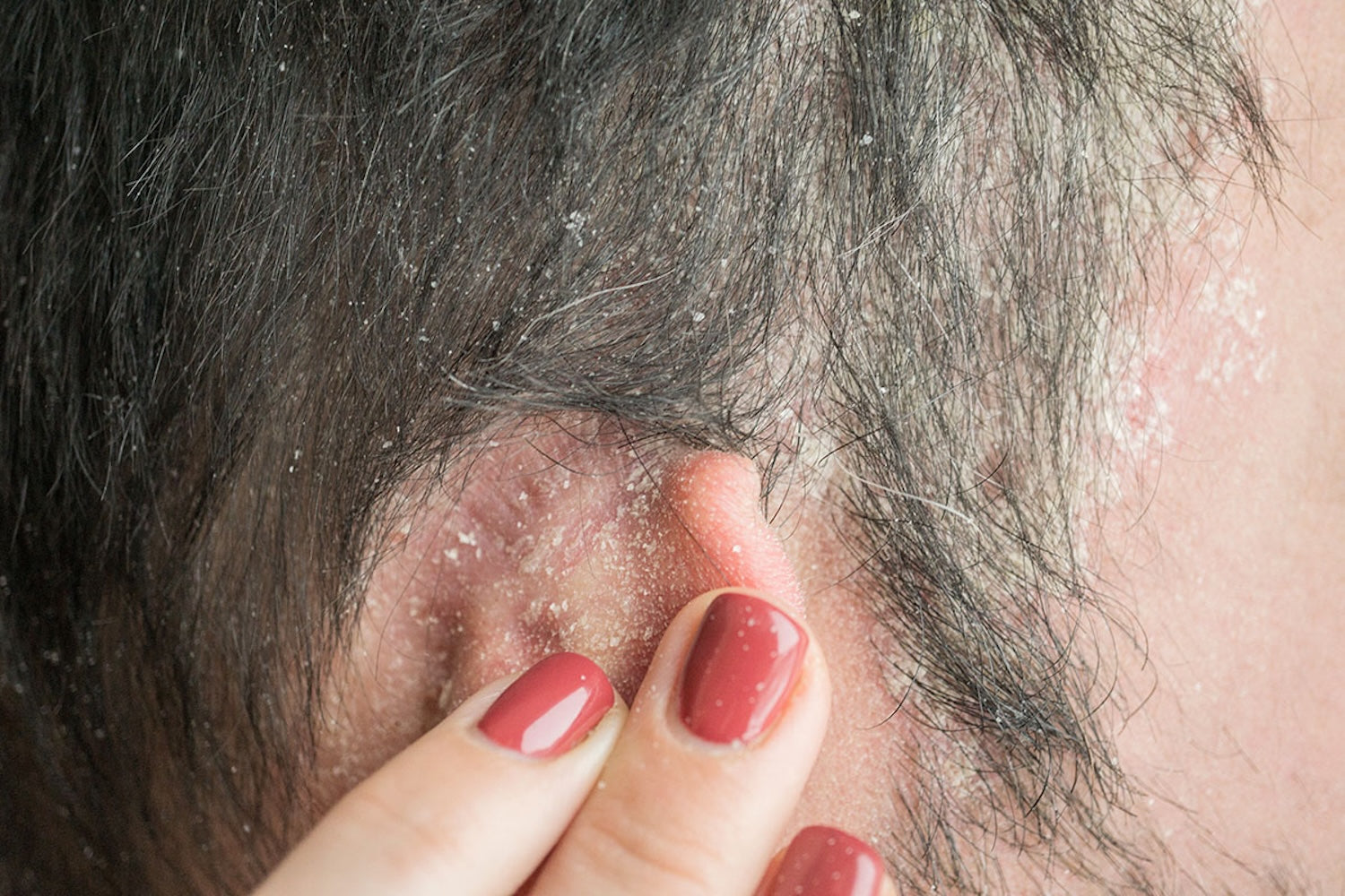 flakey scalp seborrheic dermatitis