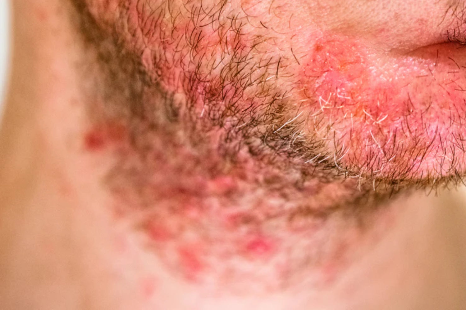 Seborrheic Dermatitis